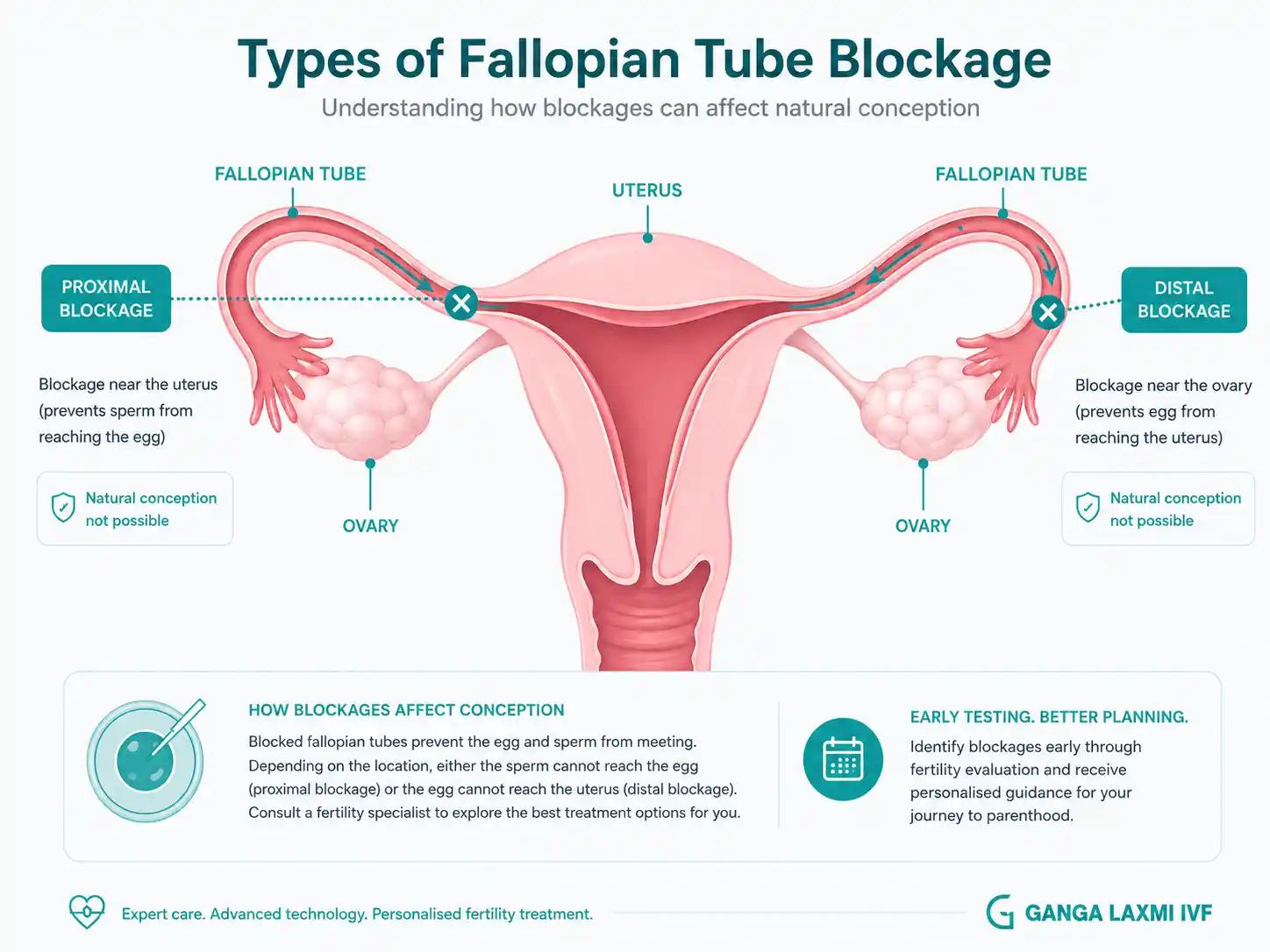 Diagram showing types of fallopian tube blockage: proximal and distal, and how they prevent natural conception